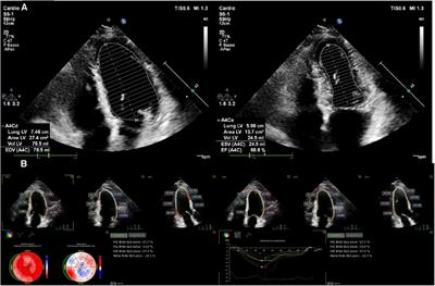 Left ventricular ejection fraction: clinical, pathophysiological, and technical limitations